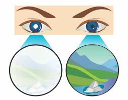 điều trị nhược thị