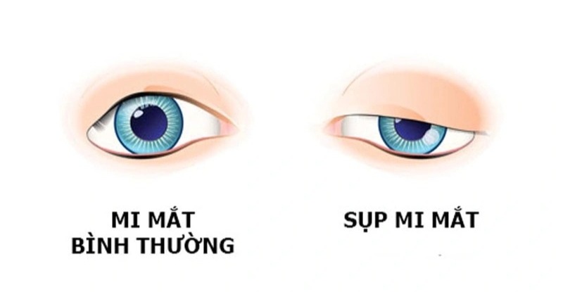 Hình ảnh mắt bị nhược thị do sụp mí