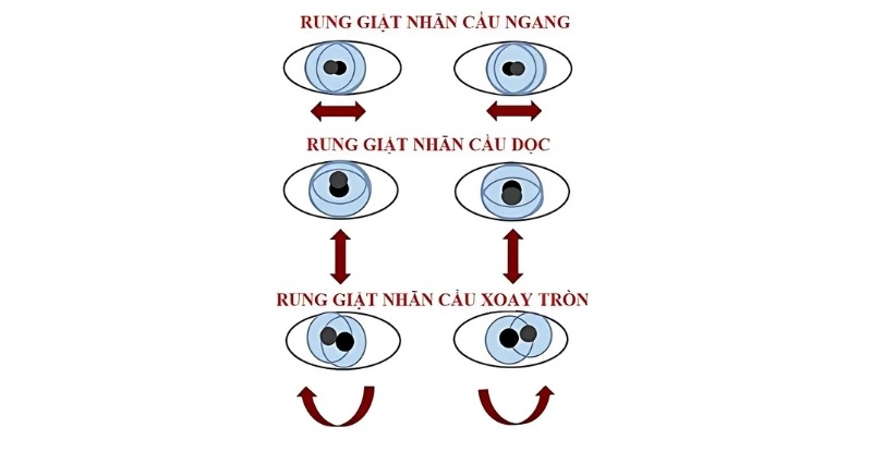 Một số dạng rung giật nhãn cầu